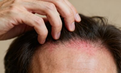 Por que o couro cabeludo coça mais à noite e como aliviar de forma simples