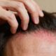 Por que o couro cabeludo coça mais à noite e como aliviar de forma simples