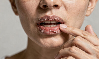 A sensação de boca seca não é apenas um incômodo passageiro