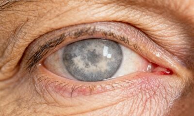 O que é glaucoma e quais os seus sintomas que podem afetar a visão ao longo do tempo