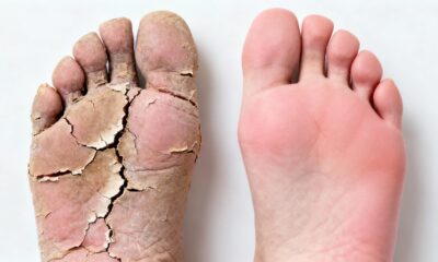 Acabe com os pés rachados usando apenas dois ingredientes potentes