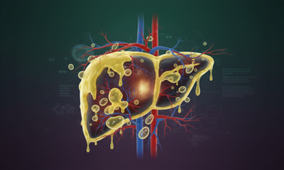 Sintomas de gordura no fígado que surgem aos poucos e muita gente não percebe
