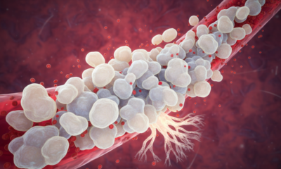 Leucócitos altos no sangue, o que pode ser e quando esse resultado merece atenção