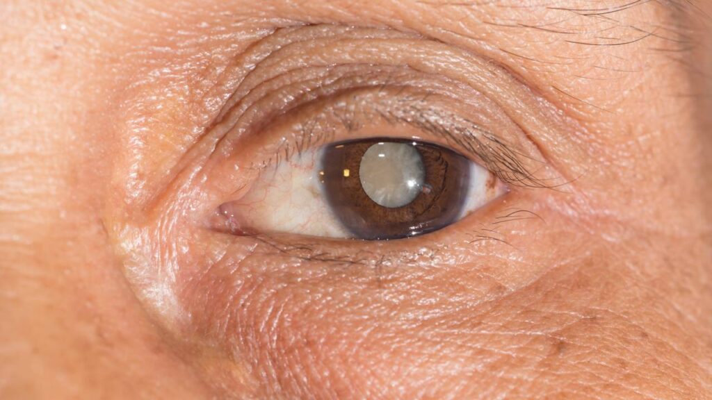 O que é glaucoma e quais os seus sintomas que podem afetar a visão ao longo do tempo