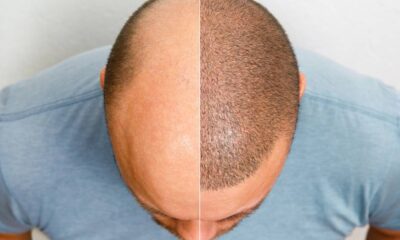 Quanto custa um transplante capilar? Guia de preços e dicas para planejar