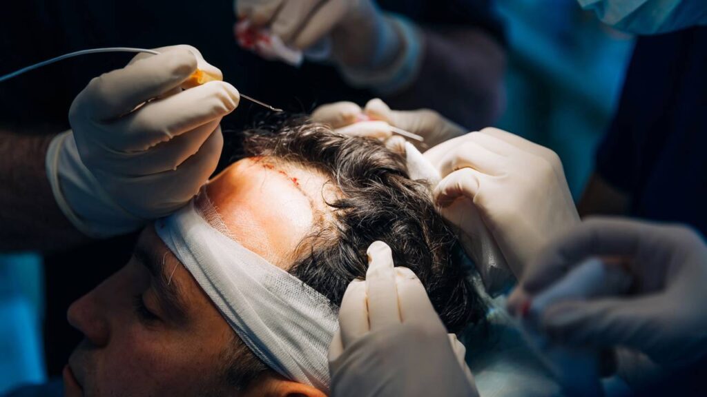 Quanto custa um transplante capilar? Guia de preços e dicas para planejar