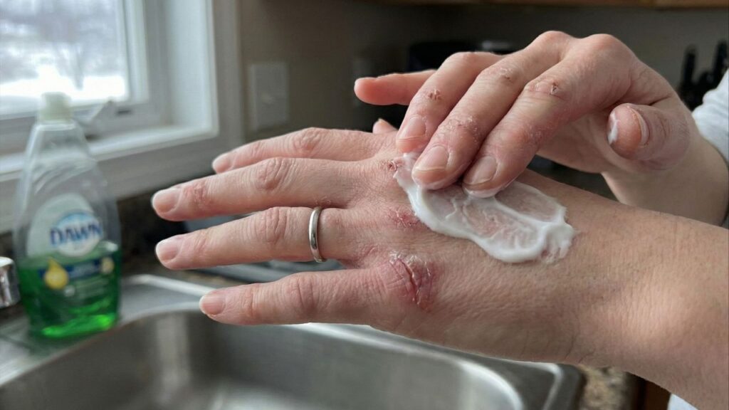 Pare de usar cremes caros e recupere suas mãos ressecadas com apenas três ingredientes