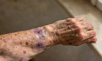 Como fortalecer a pele fina dos idosos com técnicas únicas de proteção diária