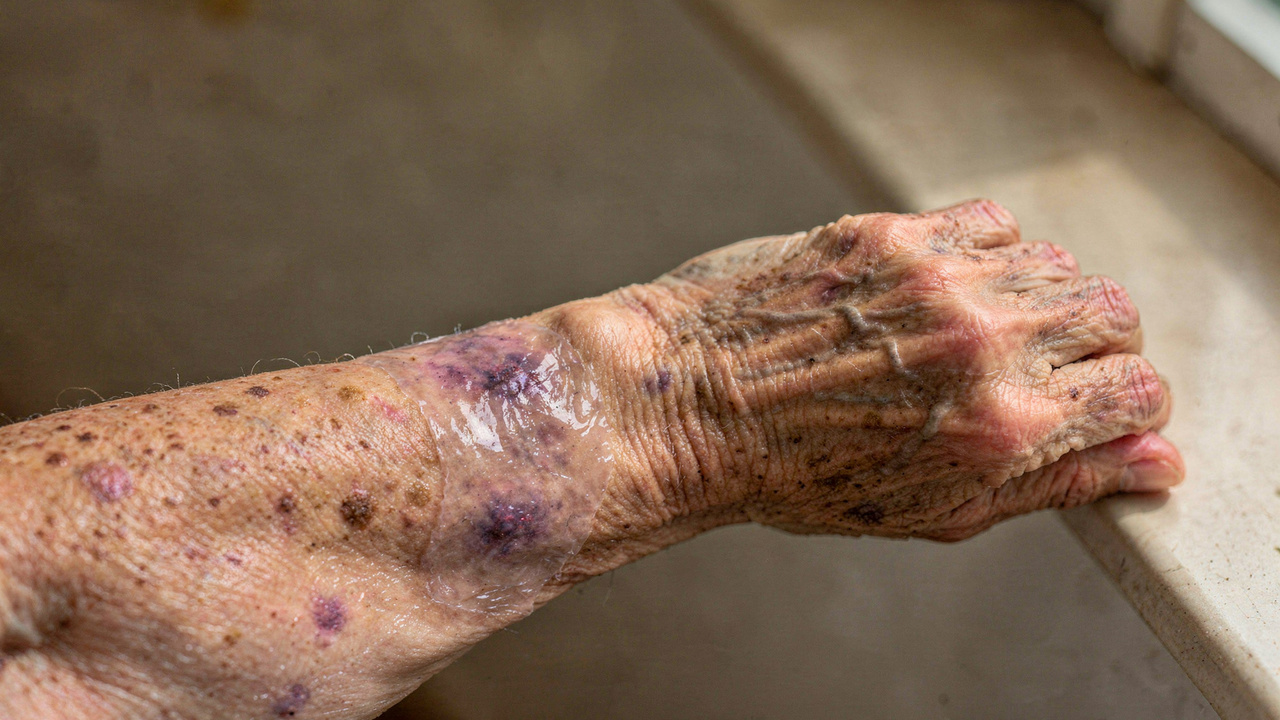 Como fortalecer a pele fina dos idosos com técnicas únicas de proteção diária