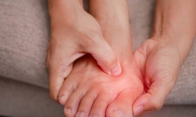 Joanete pode piorar com hábitos comuns e exercícios simples ajudam no controle e melhora