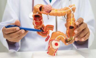 Câncer colorretal: entenda o impacto do consumo de ultraprocessados na saúde intestinal