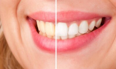 Como clarear os dentes em 7 dias com hábitos simples e cuidados seguros em casa