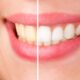 Como clarear os dentes em 7 dias com hábitos simples e cuidados seguros em casa