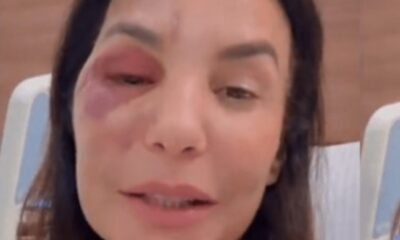 Ivete Sangalo passa por cirurgia após sofrer fraturas no rosto em acidente doméstico