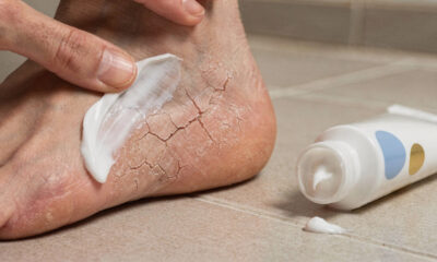Como cuidar de calcanhares ressecados e rachados em casa de forma rápida e eficiente