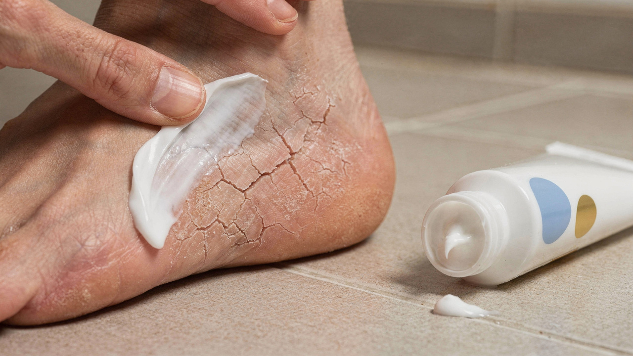 Como cuidar de calcanhares ressecados e rachados em casa de forma rápida e eficiente