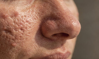 Como reduzir poros dilatados e recuperar uma pele mais limpa com uma rotina simples e eficiente