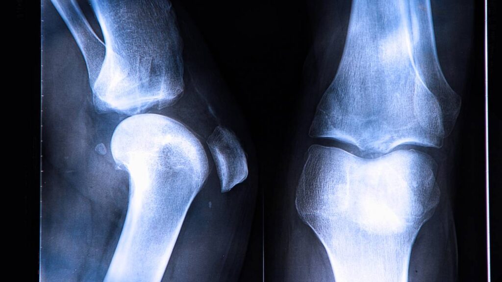 O que é a ruptura do ligamento cruzado anterior, lesão que atingiu Rodrygo e outros jogadores