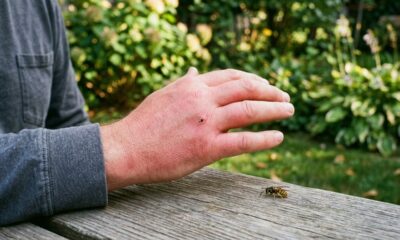Picada de vespa pode virar emergência em minutos e muita gente ignora os sinais mais perigosos