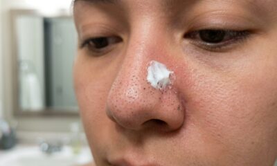Pasta de dente no nariz tira cravos rápido, mas o truque pode irritar mais do que ajudar