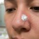 Pasta de dente no nariz tira cravos rápido, mas o truque pode irritar mais do que ajudar