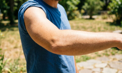 Quantos minutos de sol por dia são realmente necessários para vitamina D sem colocar a pele em risco