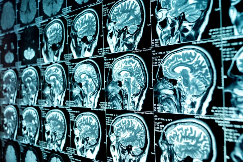Nova pesquisa desafia teoria histórica sobre amadurecimento cerebral no TDAH