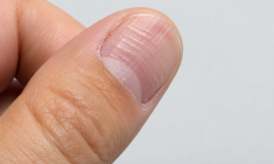 Linhas nas unhas podem parecer detalhe, mas esse sinal mostra quando vale investigar a saúde