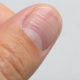 Linhas nas unhas podem parecer detalhe, mas esse sinal mostra quando vale investigar a saúde