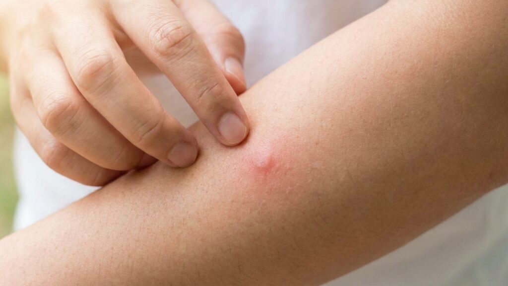 Como aliviar imediatamente a coceira da picada de mosquito com um gesto simples que confunde o cérebro