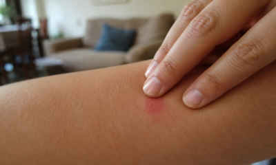 Adeus coceira sem se ferir: o gesto de dois dedos que pode acalmar picada de mosquito em segundos