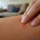 Adeus coceira sem se ferir: o gesto de dois dedos que pode acalmar picada de mosquito em segundos
