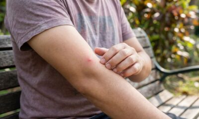 Como aliviar imediatamente a coceira da picada de mosquito com um gesto simples que confunde o cérebro