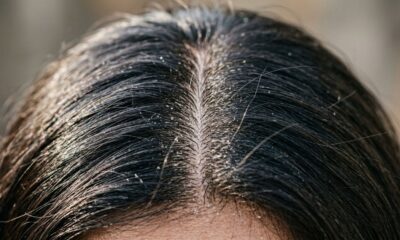 Caspa ou acúmulo de creme: dermatologistas explicam como diferenciar os sinais e cuidar corretamente do couro cabeludo