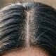 Caspa ou acúmulo de creme: dermatologistas explicam como diferenciar os sinais e cuidar corretamente do couro cabeludo
