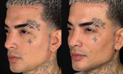 Foto comparativa do rosto de MC Guimê de perfil, antes e depois da harmonização facial