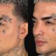 Foto comparativa do rosto de MC Guimê de perfil, antes e depois da harmonização facial