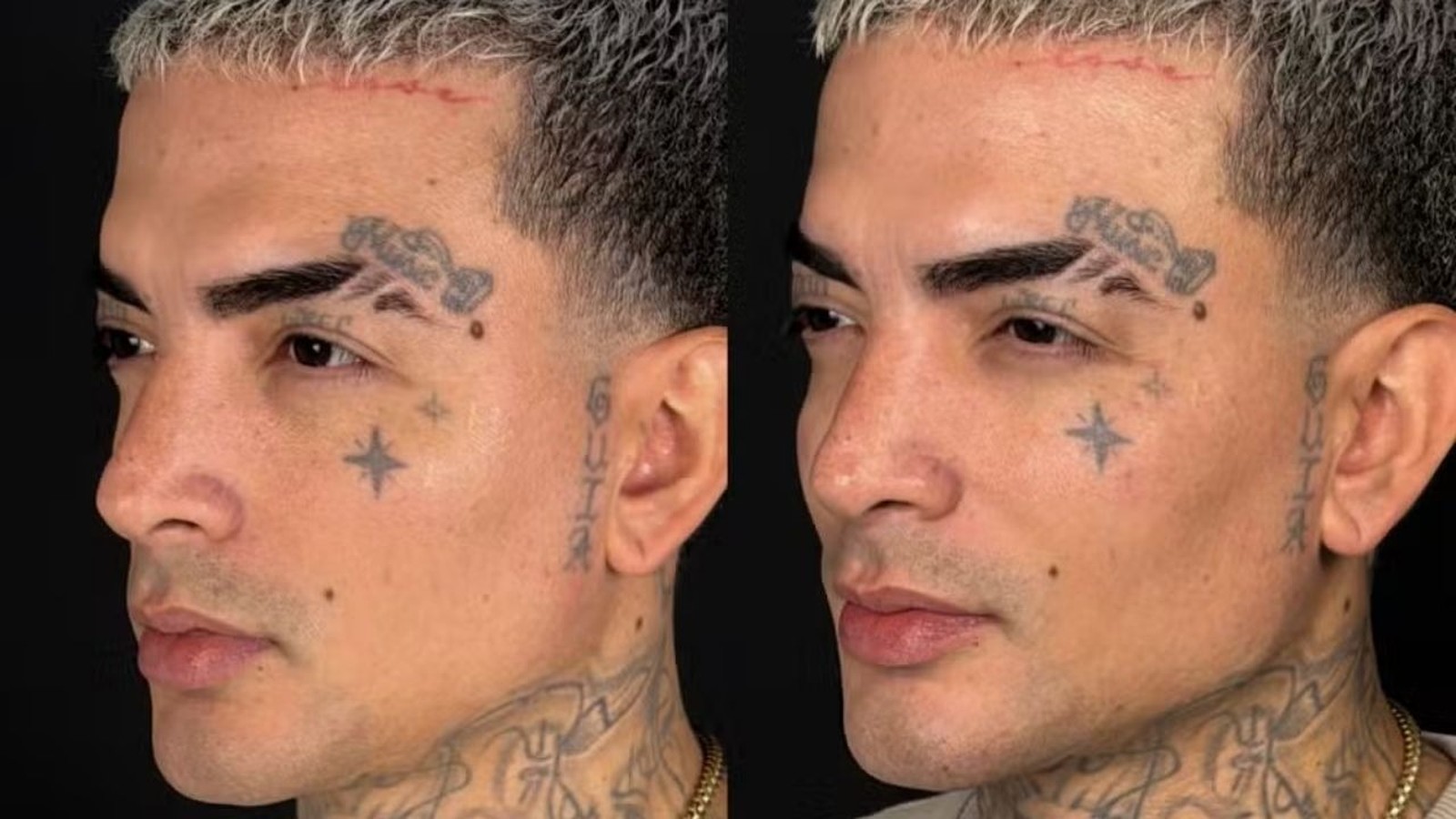 Foto comparativa do rosto de MC Guimê de perfil, antes e depois da harmonização facial