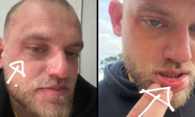 Close-up de homem barbudo com rosto e lábio feridos, apontando para o corte na boca