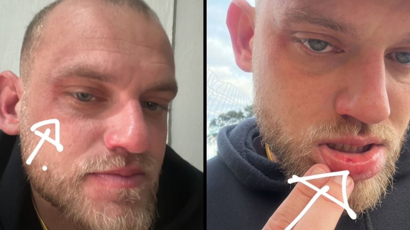Close-up de homem barbudo com rosto e lábio feridos, apontando para o corte na boca