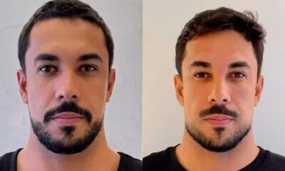 Maike em duas fotos lado a lado mostrando antes e depois de harmonização facial