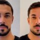 Maike em duas fotos lado a lado mostrando antes e depois de harmonização facial