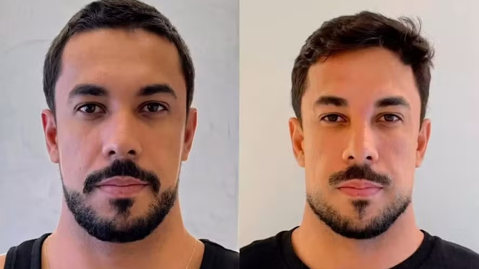Maike em duas fotos lado a lado mostrando antes e depois de harmonização facial