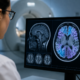Ressonância magnética pode revelar sinais de Alzheimer ao acompanhar mudanças no cérebro antes da demência avançar?
