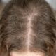 Segundo a psicologia, a queda de cabelo não significa falta de cuidado, mas pode reforçar a necessidade de reduzir o estresse e cuidar da autoestima