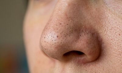 Nem espremer, nem usar pasta de dente: dermatologistas revelam o jeito mais seguro de cuidar dos cravos em casa sem machucar a pele