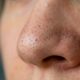 Nem espremer, nem usar pasta de dente: dermatologistas revelam o jeito mais seguro de cuidar dos cravos em casa sem machucar a pele