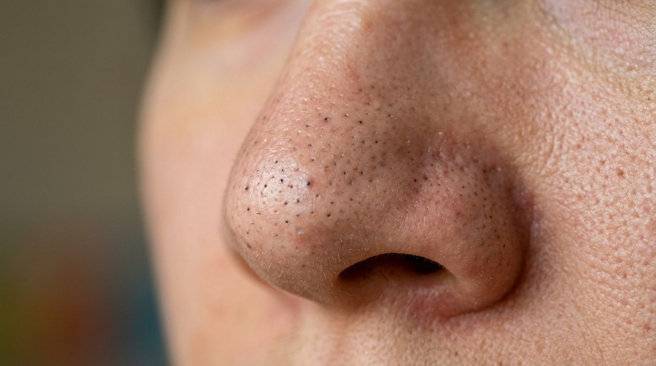 Nem espremer, nem usar pasta de dente: dermatologistas revelam o jeito mais seguro de cuidar dos cravos em casa sem machucar a pele