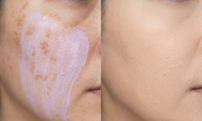 Maçã do rosto com melasma sendo neutralizado com corretivo lilás e finalizado com uma camada leve de base.