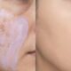 Maçã do rosto com melasma sendo neutralizado com corretivo lilás e finalizado com uma camada leve de base.